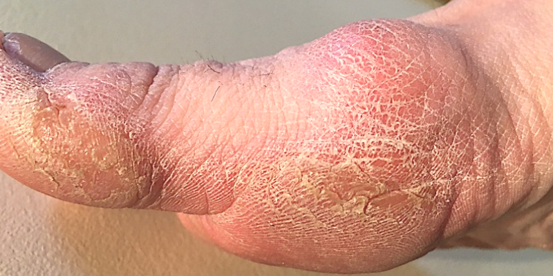 Corns, calluses, bunions are ugly feet conditions