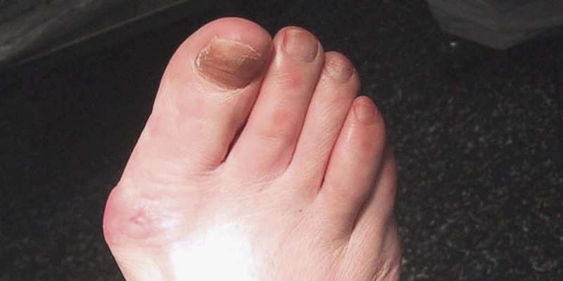 Do you hate your bunions?